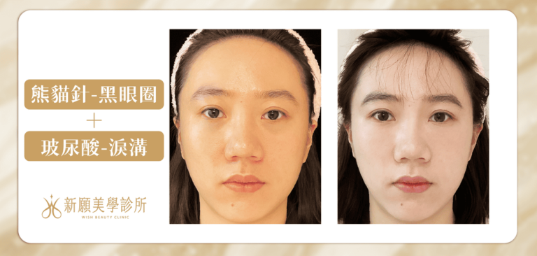 新願美學診所｜改善熊貓眼黑眼圈｜熊貓針玻尿酸