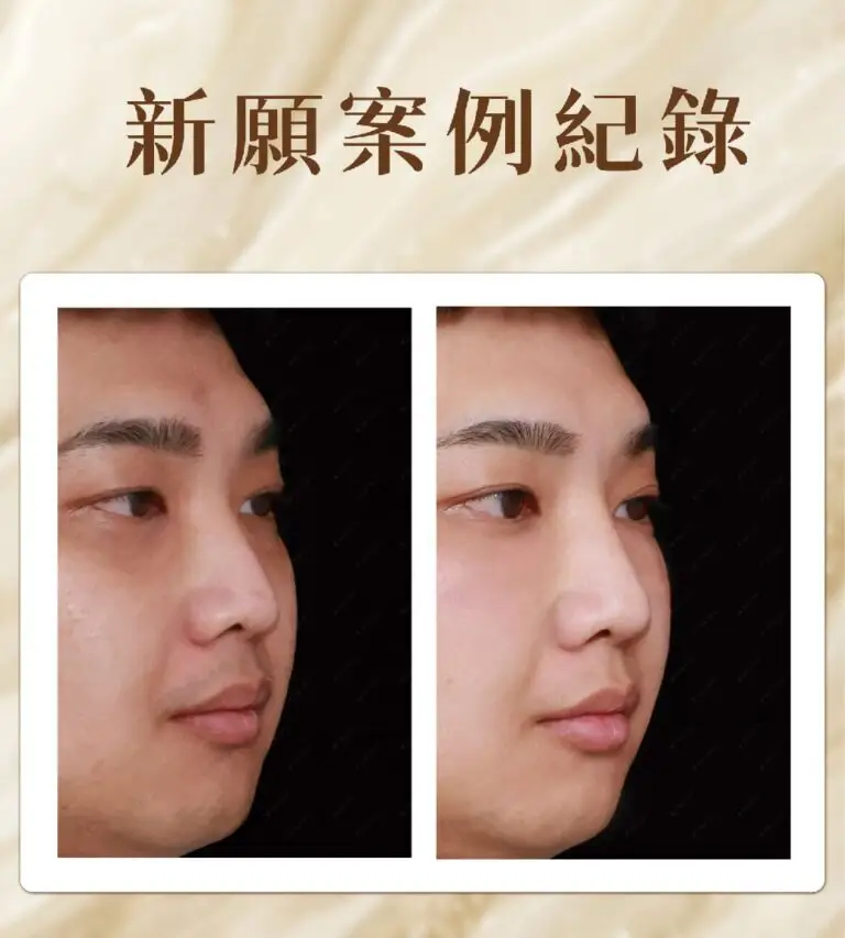 鼻雕案例照