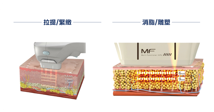 海芙音波第三代效果好嗎？超高CP值！價格、探頭、痛感全解析