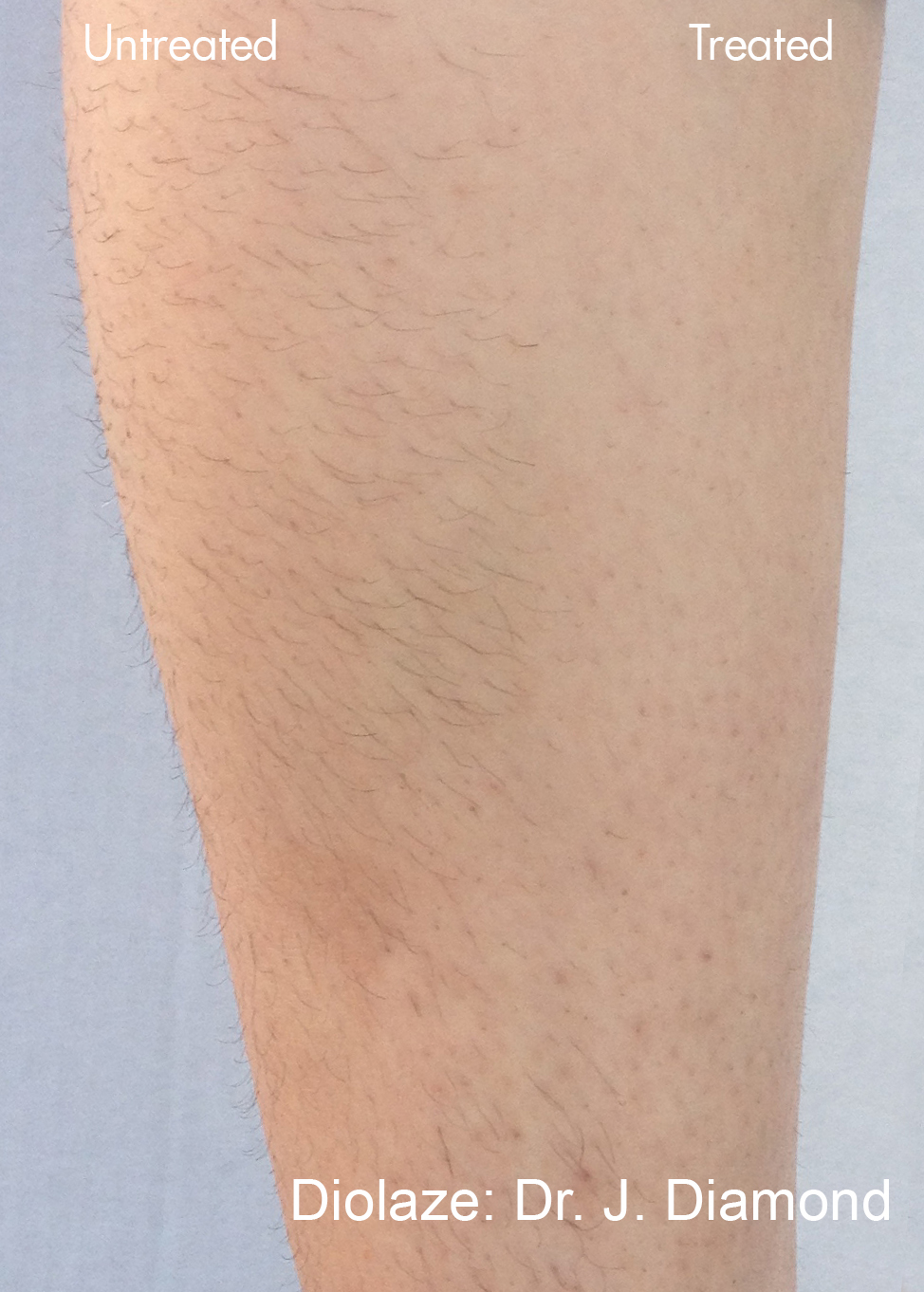 JD_Diolaze_1d_1tx_30J_Strong-Cooling_Short-Pulse