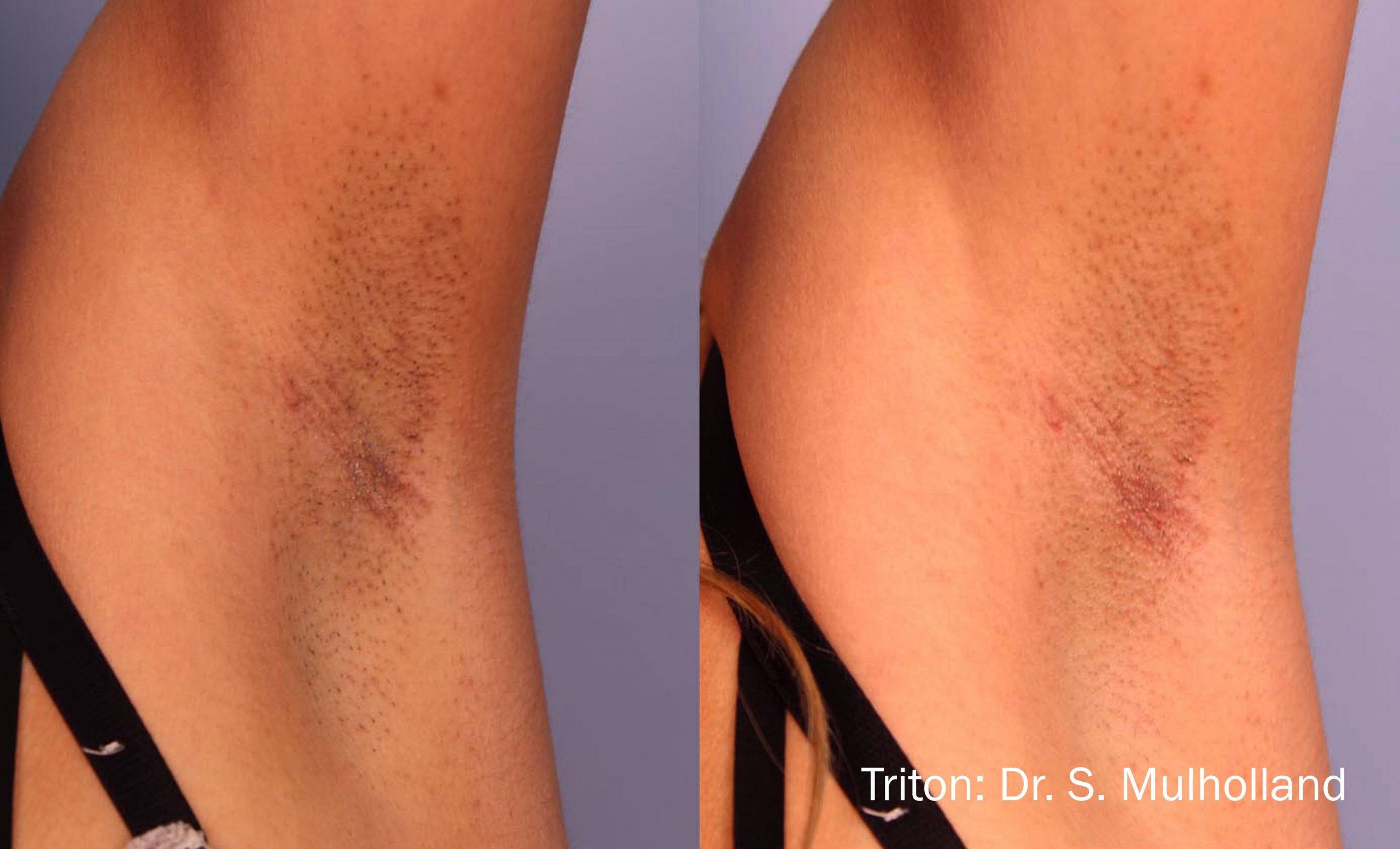 SM_2a_Triton_Underarm_LR-scaled