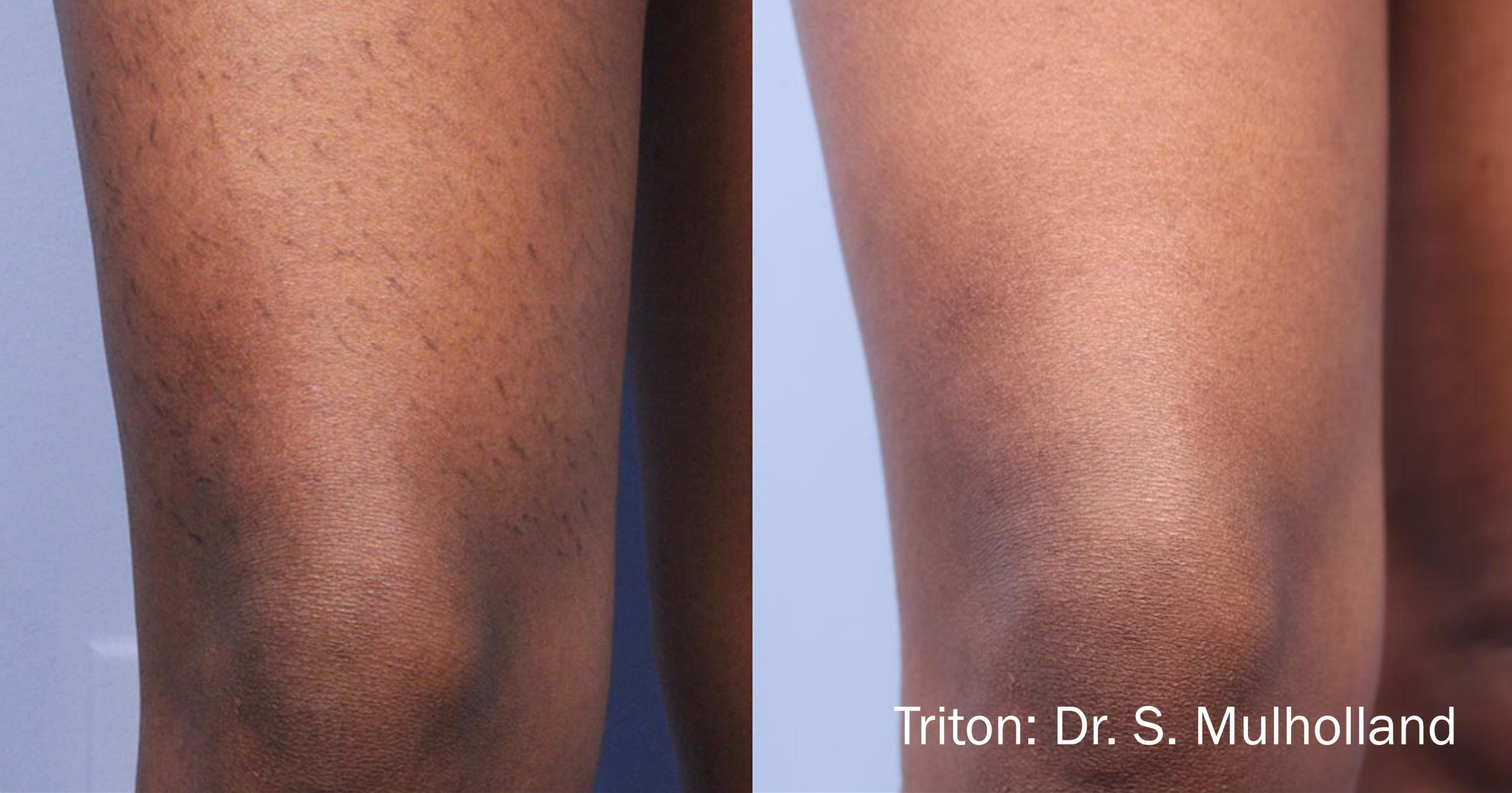 SM_3a_Triton_Knees_LR-scaled