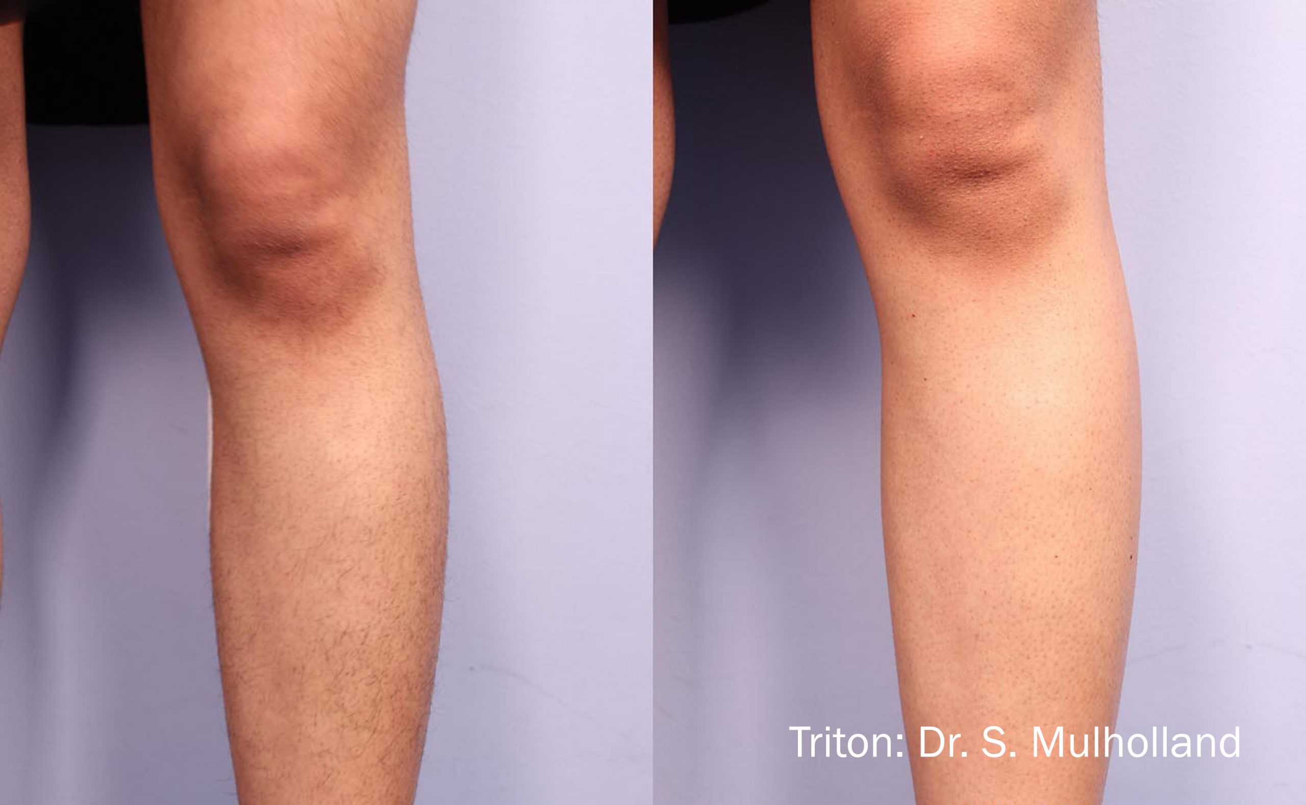 SM_4a_Triton_Legs_5tx_6monthspost_LR-scaled