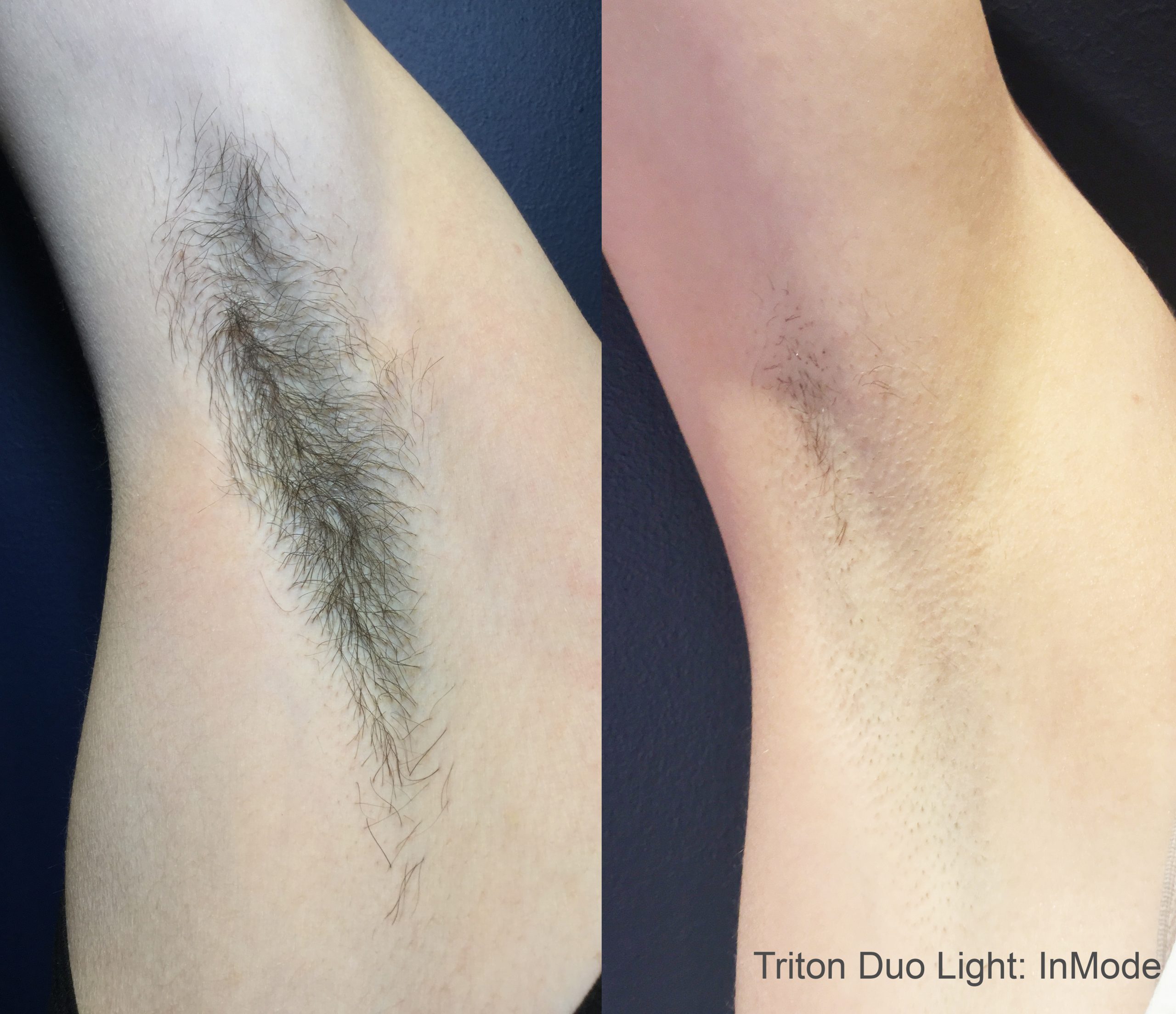 TritonDuoLight_1tx_NoShaving3Weeks-scaled