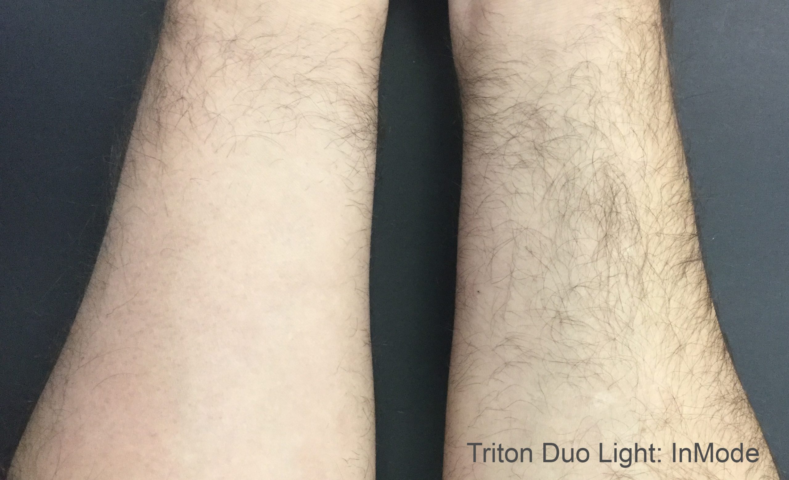 TritonDuoLight_3tx-scaled